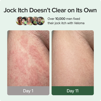 Soothe Antifungal Soap For Jock Itch